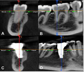 Evaluation of the marginal bone loss