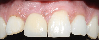 Implant loaded