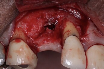 uncovery residual lack of ridge contour