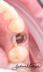 Pre-op view showing non-restorable tooth with extensive decay