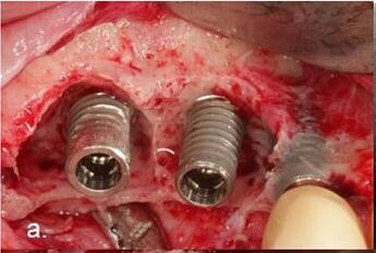 implants 15 and 16 with severe defects