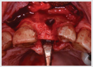 Mucoperiosteal flap elevated to expose defect