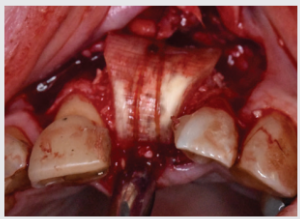 Periosteal stabilizing suture
