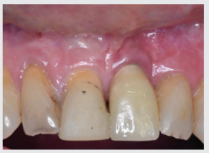 The implant was restored with a screw-retained crown