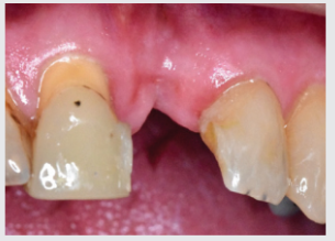 Patient presents with missing tooth No. 9