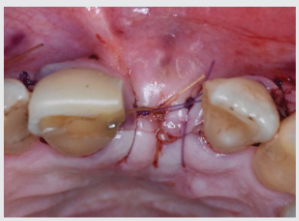 Tension-free primary closure