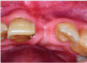 Occlusal view showing obvious buccal alveolar ridge deficiency