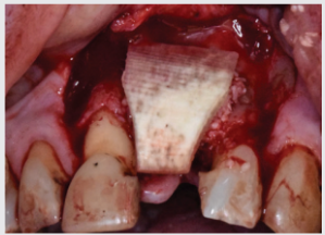 Demineralized cortical sheet placed