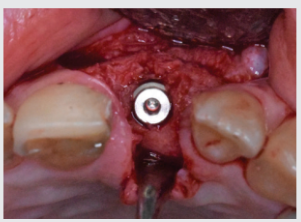Implant fixture placed