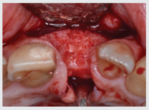 Flap elevation reveals nicely reconstructed ridge