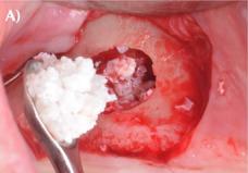 filling of the sinus region with DBBM