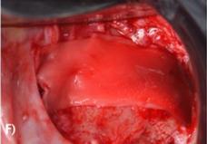 H‐PRF membrane covering the collagen membrane