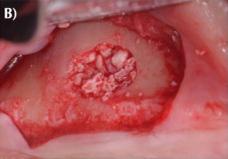 collagen membrane covering the lateral window