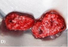 H‐PRF bone block graft