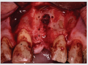 Cortical perforations