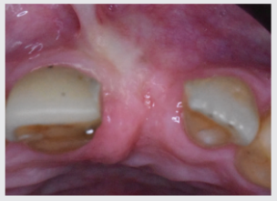 At 6 months, the grafted ridge has healed well