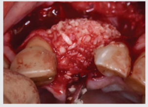 Deficient ridge grafted