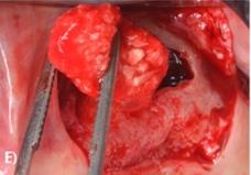 H‐PRF bone block insertion